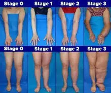 Lymphedema stages